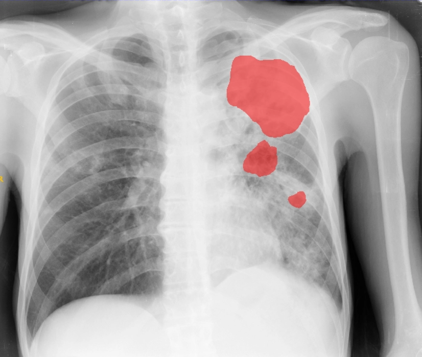 Task 1: CXR with Cavity Annotations